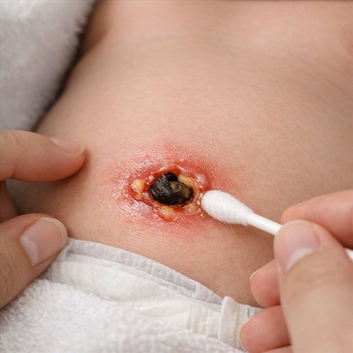Comment savoir si le cordon ombilical de bébé s’infecte ?